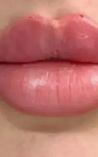 تزریق ژل و فیلر بوتاکس
