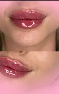 ژل گونه چونه زاویه سازی درجشنواره مشاوره رایگان