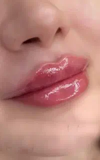 اقتصادی زیبا شو با فیلر بوتاکس و نخ لیفت