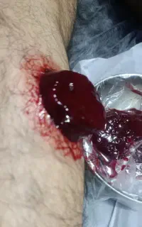 حجامت درمانی و ریکاوری و بادکش تخصصی