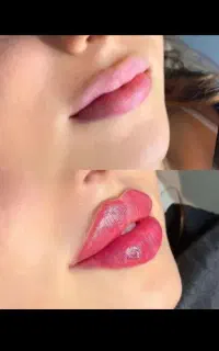 فیلر بوتاکس،مزو، نخ
