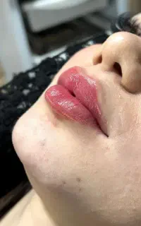 فرصت استثنایی مدل فیلر لب /گونه /چانه