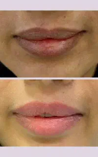 تغییر رنگ لب با لیزر واترلیز در بندرعباس/ اقساط