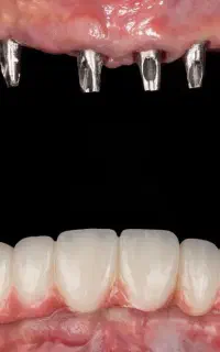 دندانپزشکی تخصصی/ ایمپلنت/ روکش ایمپلنت/ لمینت