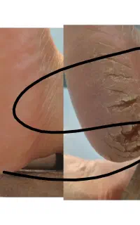 اسپا،از بین بردن ترک ها در یک جلسه فقط ۲۵۰ تومان