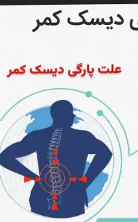 راهنمایی کنید در مورد پارگی دیسک کمر
