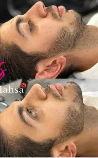 تزریق فیلر لب،ژل لب، بوتاکس،زاویه سازی،لب روسی