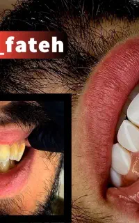 کامپوزیت ونیر در یک جلسه