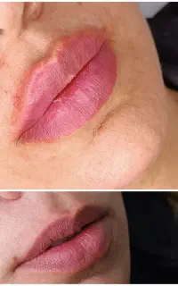 ژل \بوتاکس \لیزر مطب صدف (رویال سابق) تخفیف بوتاکس