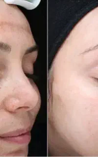 پاکسازی و جوانسازی پوست و رفع عارضه