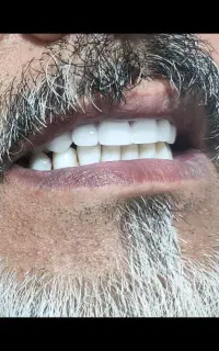 ساخت دندان مصنوعی با بهترین چیدمان و طرح لمینت