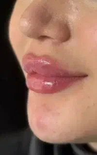 جشنواره آخر تابستان(تزریق فیلر و بوتاکس و جوانساز)