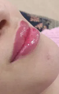 انجام کلیه خدمات فیشیال.فیلر.بوتاکس