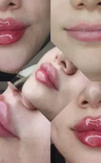 تزریق ژل