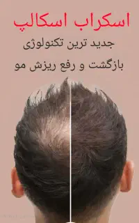 اسکراب اسکالپ درمانی مو و رفع ریزش، اِسپا سر