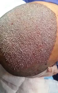 کاشت مو وابرو،میکرو کاشت