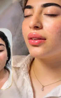 ژل بوتاکس لیزر