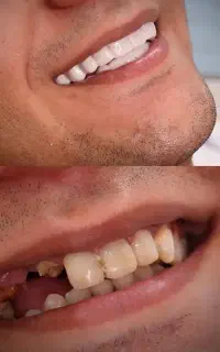 لمینت متحرک دندان