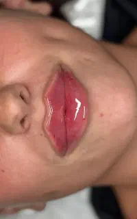 تزریق فیلر و ژل
