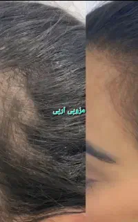 ساکشن تزریق شکم‌پهلوبازوران