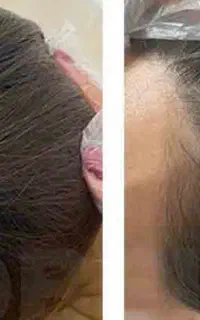 کاهش چربی ولاغری  و رشدمو بادستگاه