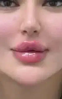 تخفیف ژل‌و‌بوتاکس