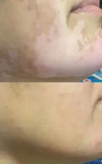 فقط یک دوره بدون کورتون / ویتیلیگو / پیسی