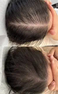 رویش سریع ریش و مو تضمینی