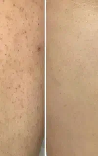 تنها لیزر موی تضمینی سبزوار