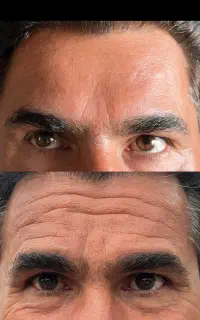 فقط امروز بوتاکس ۹۰۰ژل هر سی سی1600