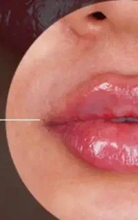 تخفیف ویژه تزریق فیلر