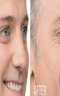 بوتاکس
