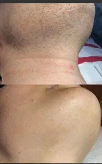 الکترولیزموهای زائد