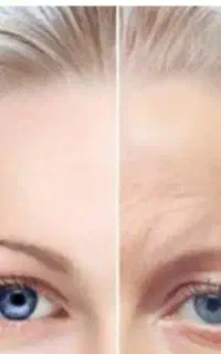 تزریق بوتاکس