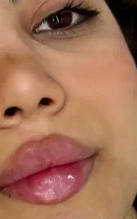 ژل فیلر بوتاکس مزوتراپی آنزیم وبادی و آموزش در مطب