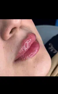 تخفیف بوتاکس۷۵۰نخ کاگ۲۳۰۰جراحی لیفت شقیقه ابرو ۱۸