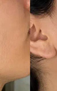 از بین بردن دائم موهای سفید و مشکی بدن و صورت