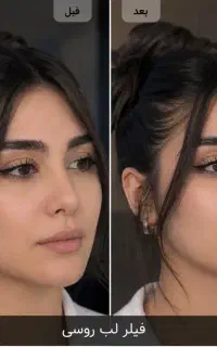 تزریق ژل(فیلر)بادی آنزیم بوتاکس مادلینگ لیفت مزو