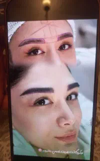 انجام کاشت ابرو مو ریش بلفارو دایرکت ابرو
