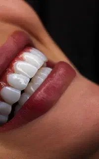 کامپوزیت،روکش،لمینت و