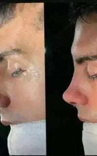 جراحی زیبایی بینی با۲۹میلیون