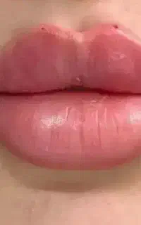 تزریق ژل و بوتاکس