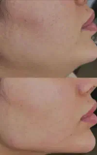 اف مزو، و فیلر ب مدت محدود