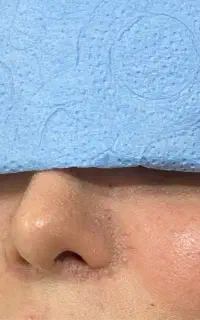 ژل ، بوتاکس ، پی ار پی، مزو ، مزوژل و