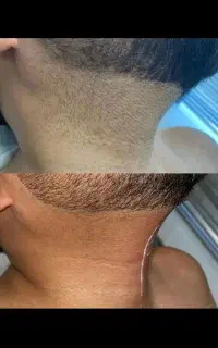 لیزر موهای زائد صورت وبدن، جوانسازی صورت