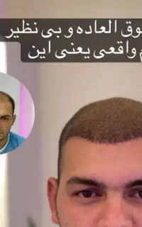 کاشت مو ریش  ابرو و زیبایی