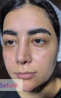 بلفاروپلاستی با بخیه های لیزری