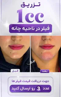 ژل بوتاکس پی آر پی اسپارتینا اقساطی با چک صیادی