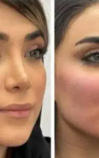 تزریق ژل و بوتاکس