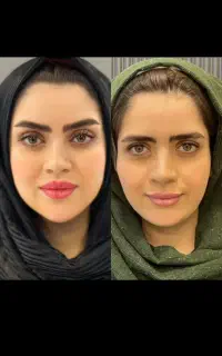 هودوپلاستی و پرینورافی